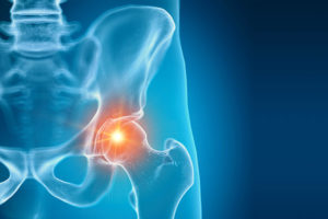 Piriformis syndrome sciatica hip back pain